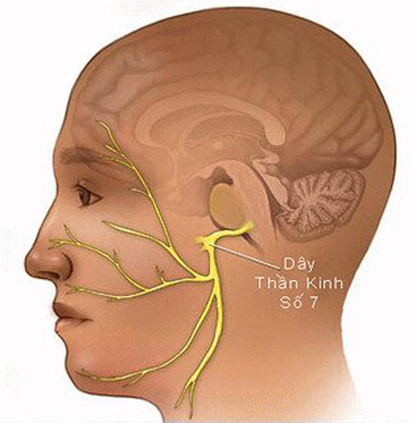 Liệt dây thân kinh số 7