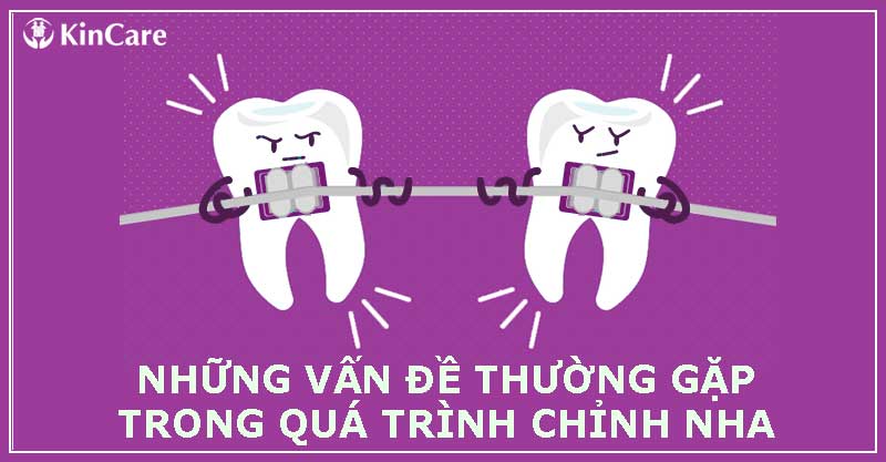 Những vấn đề thường gặp trong quá trình niềng răng