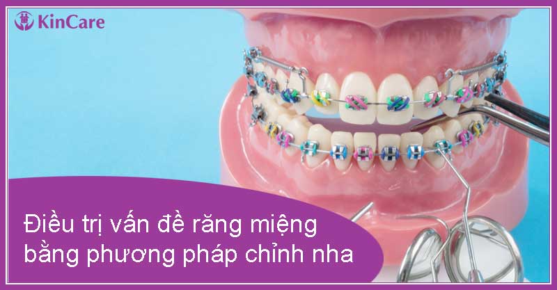 Điều trị các vấn đề răng miệng bằng phương pháp chỉnh nha