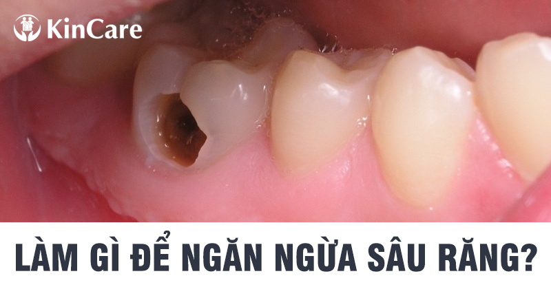 Để ngăn ngừa sâu răng thì nên làm gì? Để ngăn ngừa sâu răng thì nên làm gì?