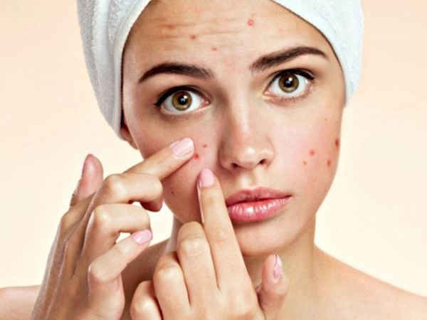 Cảnh báo nghiêm trọng khi mẹ bầu dùng kem trị mụn sai cách