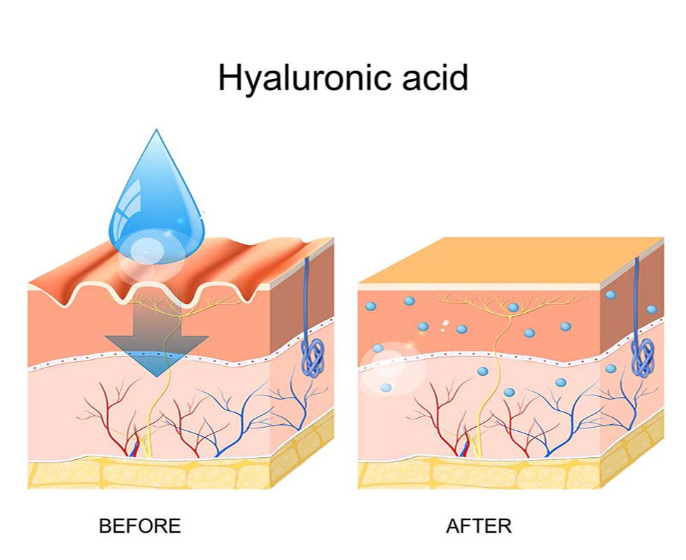 Làn da trước (trái) và sau (phải) khi dùng Hyaluronic Acid