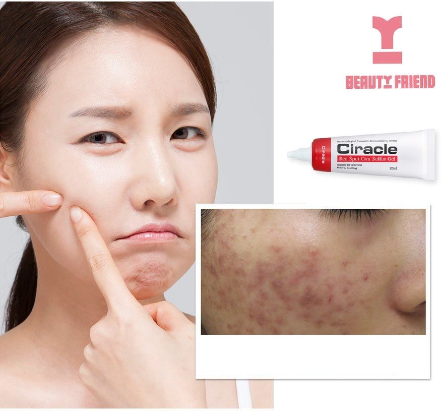 Mụn trứng cá đáng ghét ư? Đừng lo, đã có Ciracle Red Spot Cica Sulfur Gel