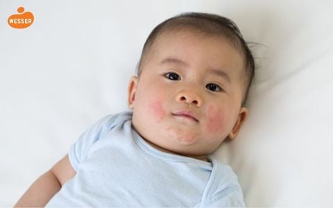 Rôm sảy ở trẻ nhỏ: Mẹo ngăn ngừa và chăm sóc rôm sảy cho bé hiệu quả