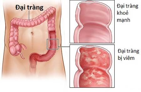 Viêm loét đại tràng xuất huyết nặng: sự hồi phục ngoạn mục của ...