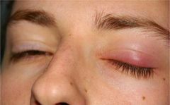 Lẹo mắt và chắp là gì? Nguyên nhân gây ra lẹo và chắp mắt?