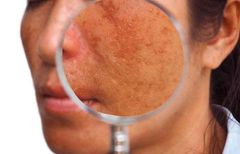 Sắc tố da là gì và nó có phải lý do gây ra các đốm đen trên khuôn mặt?