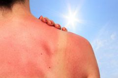 Tác hại của cháy nắng đến da như thế nào? Mức độ nguy hiểm khi da bj cháy nắng