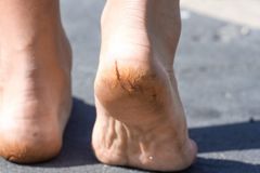 Tình trạng nứt gót chân? Trị nứt gót chân bằng nhựa đu đủ có hiệu quả hay không?