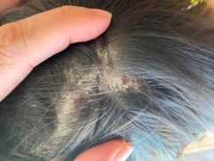 Nấm da đầu là gì? Nguyên nhân, dấu hiệu và cách điều trị nấm da đầu