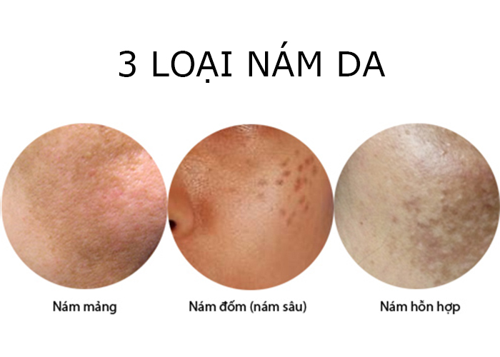 Nguyên nhân và Phân biệt các loại nám da I Mỹ Viện Thanh Thủy