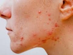 Nguyên nhân gây ra da mụn và giải pháp dưỡng da
