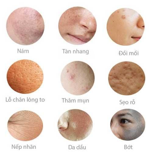 phân biệt nám da - mỹ viện thanh thủy