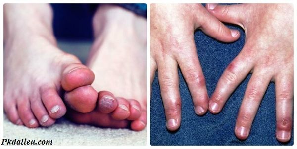 Bệnh cước chân tay mùa đông nếu không điều trị kịp thời rất nguy hiểm