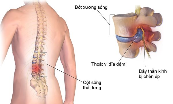 Thoát vị đĩa đệm