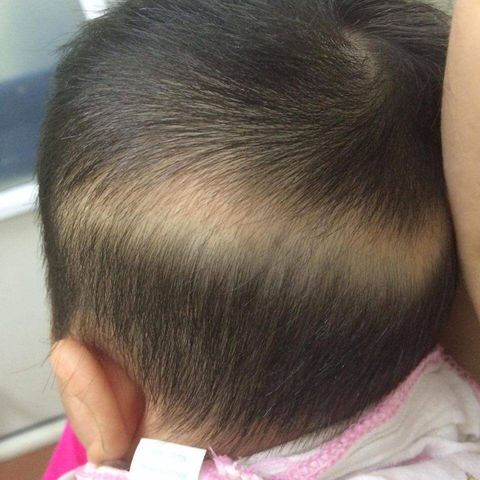 Trẻ sơ sinh bị rụng tóc: Nguyên nhân và cách chữa chính xác