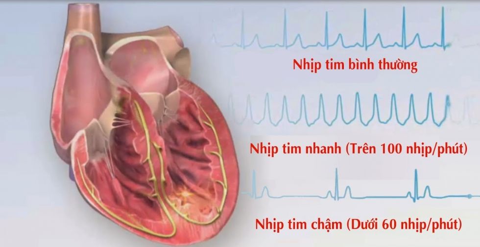 Dấu hiệu bệnh tim mạch và nhận biết các bệnh về tim nguy hiểm!