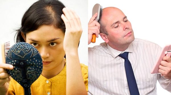 Cách trị hói đầu hiệu quả nhất hiện nay.