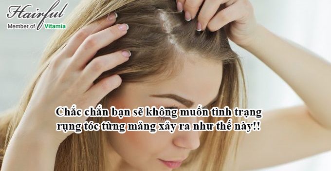 Thuốc chữa rụng tóc từng mảng, hói đầu – chữa hiệu quả từ công thức Mỹ!