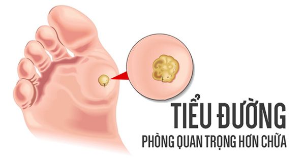 Không muốn bị tiểu đường, cần tránh những yếu tố gây bệnh ngay từ trong 