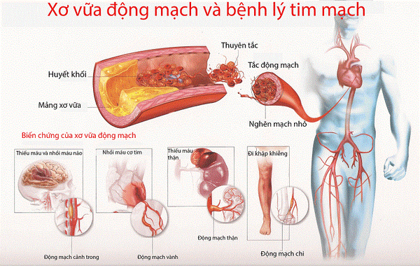 Xơ vữa động mạch – Nguyên nhân, triệu chứng và cách chữa trị tốt nhất