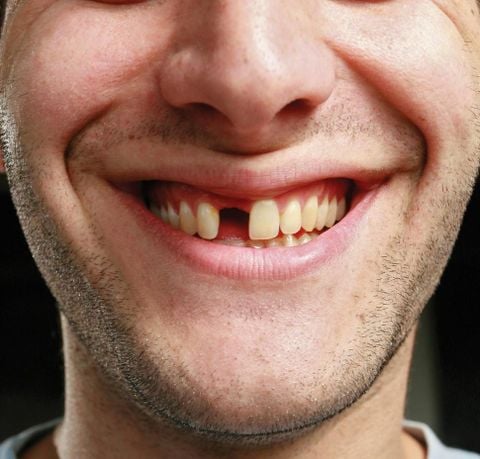 Những thói quen khiến bạn chưa già mà răng đã rụng