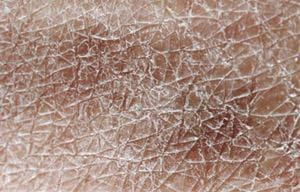 Các nhân tố bên trong và bên ngoài có thể ảnh hưởng đến khả năng giữ ẩm của da