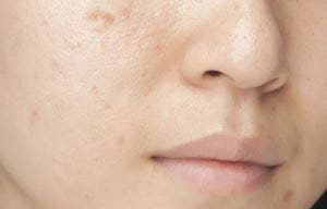 Làn da dầu thường có nhiều nhược điểm