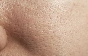 Đặc tính của da dầu là lỗ chân lông to có thể thấy được