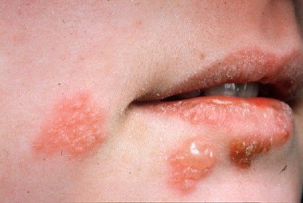 Virus Herpes miệng hay còn gọi là mụn rộp ở miệng
