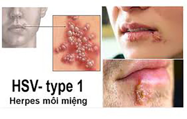 Nổi mụn nước (Herpes miệng) sau xăm.