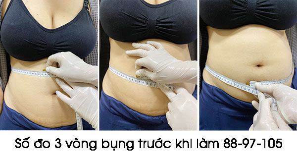 Kết quả công nghệ giảm béo đa tầng Lipo-X tại Thái Lan
