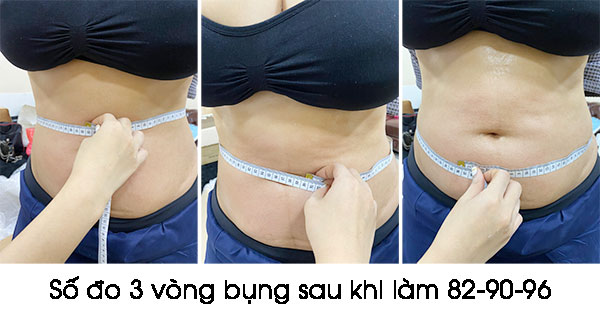Kết quả công nghệ giảm béo đa tầng Lipo-X tại Thái Lan 1