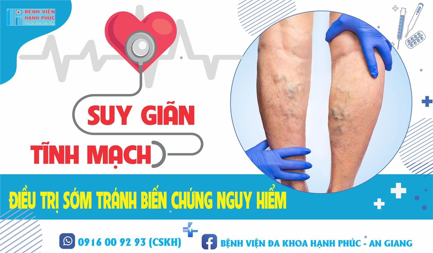 SUY GIÃN TĨNH MẠCH CHÂN - PHÁT HIỆN SỚM VÀ ĐIỀU TRỊ TRÁNH BIẾN CHỨNG NGUY HIỂM