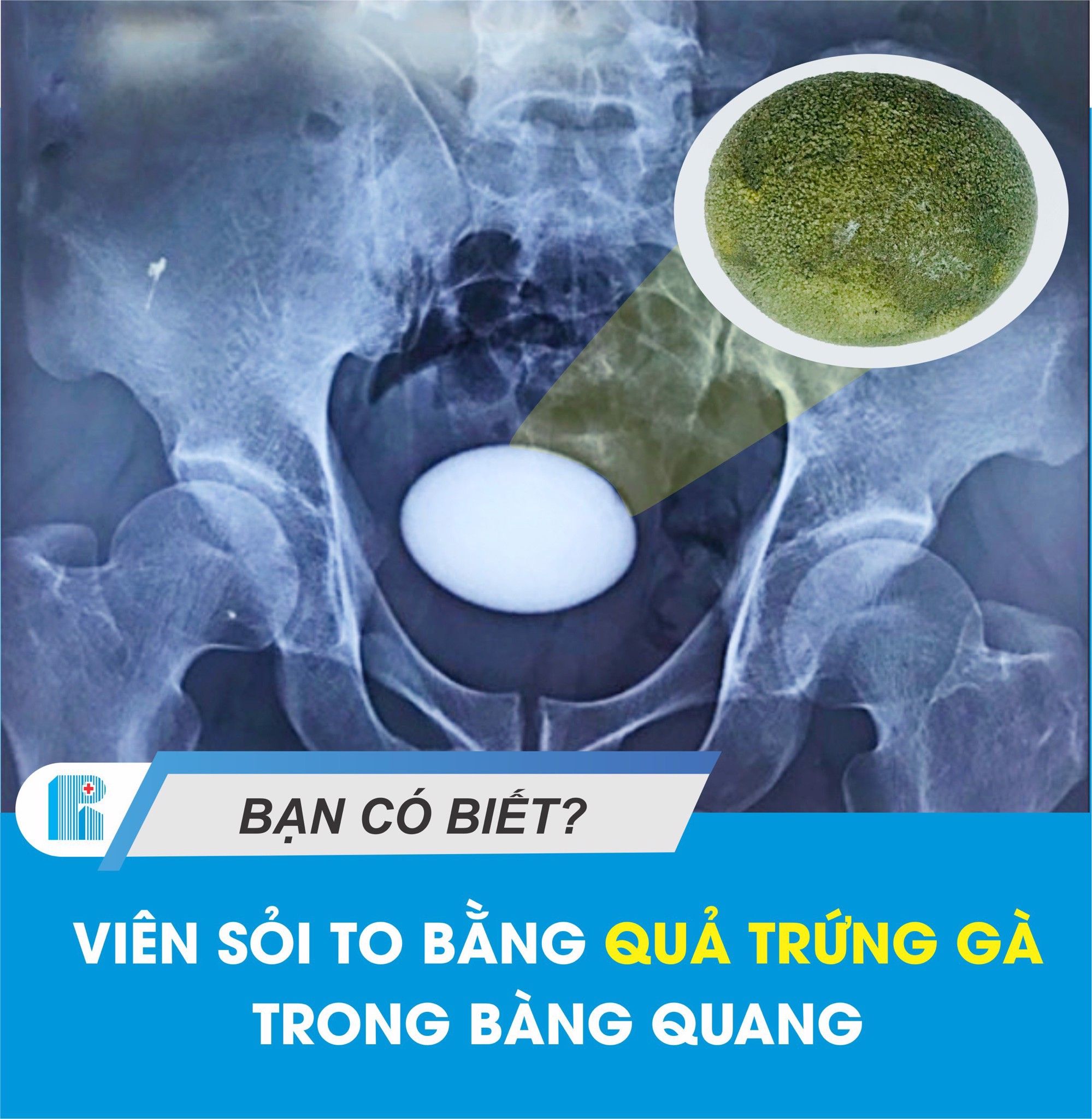 VIÊN SỎI TO BẰNG 