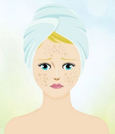 3 Cách Trị Mụn Ẩn Tại Nhà