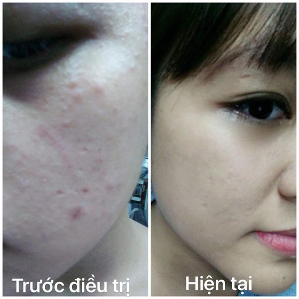 Điều Trị Da Nhiễm Corticoid