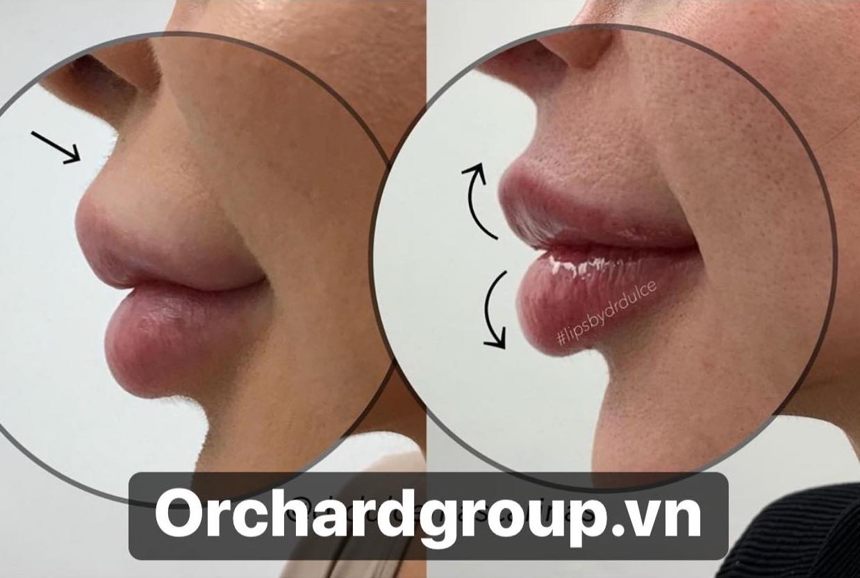 Tiêm filler môi cần kiêng gì? Chuyên gia Orchard giải đáp