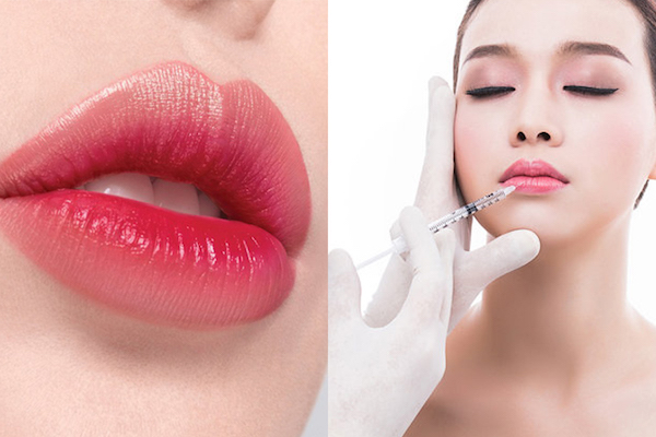 3 dáng tiêm filler môi đẹp lung linh đốn tim hội chị em