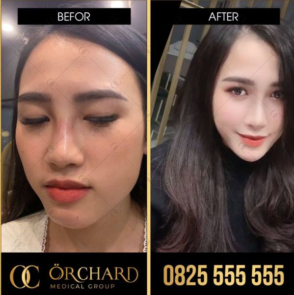 Trước và sau khi tiêm filler