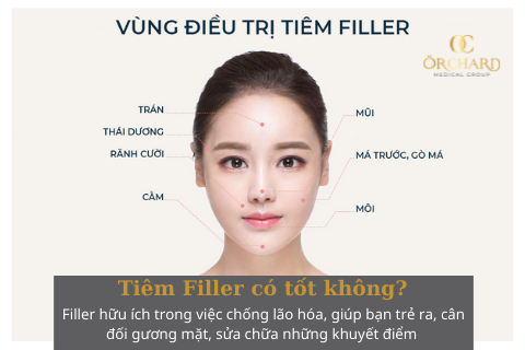 Tiêm Filler có tốt không?