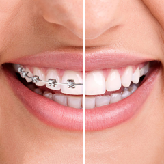 how long does dental braces treatment last