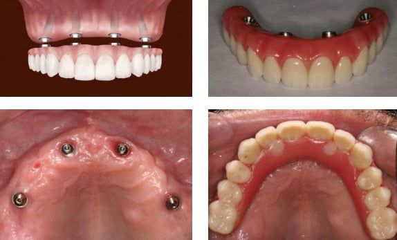 https://file.hstatic.net/1000259350/file/all-on-4-dental-implants-6_grande.jpg