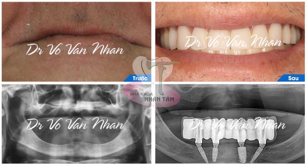 All on 4 Khắc phục tình trạng tiêu xương, móm sau khi mất răng hiệu quả