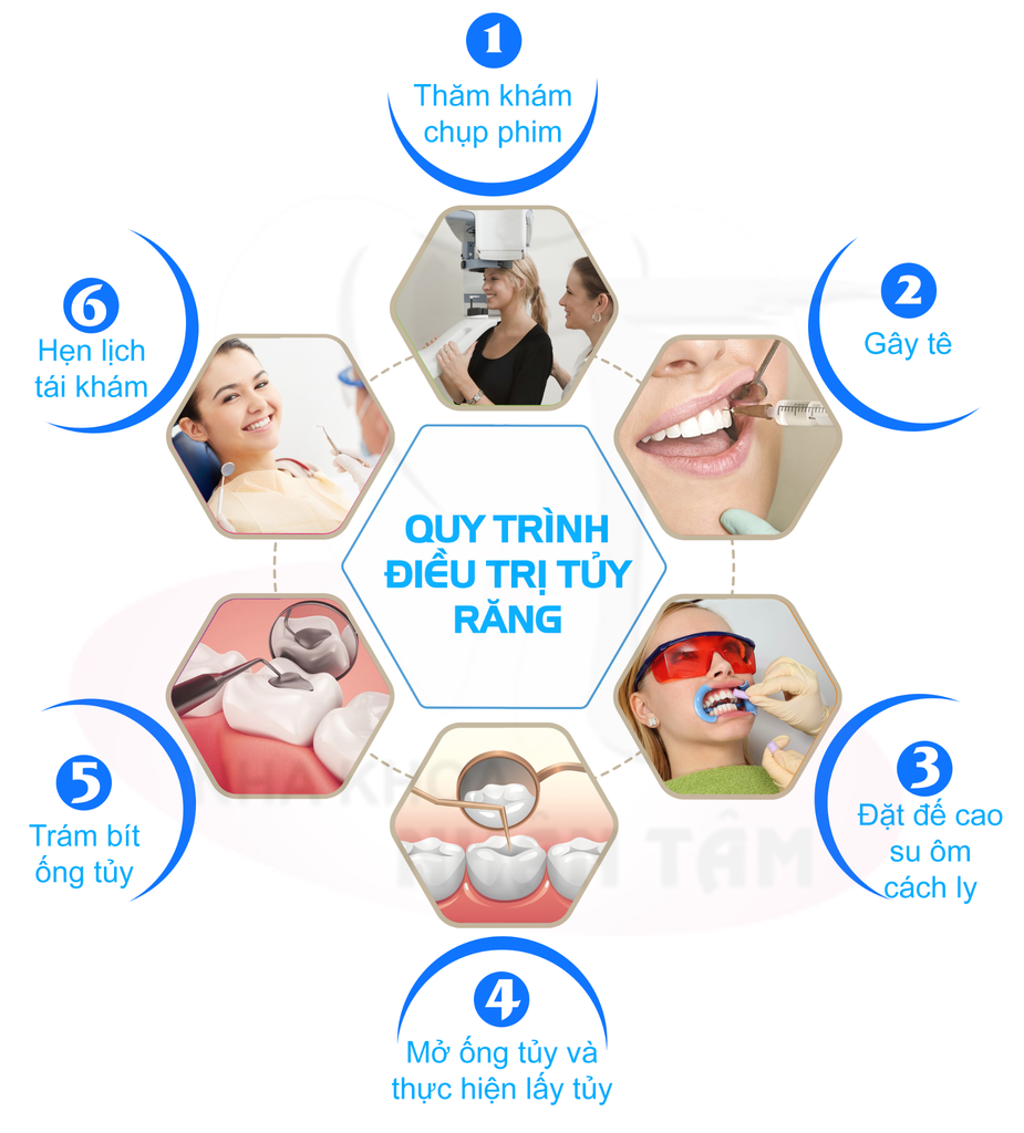 Điều trị tủy răng ở đâu tốt? – Nha Khoa Nhân Tâm