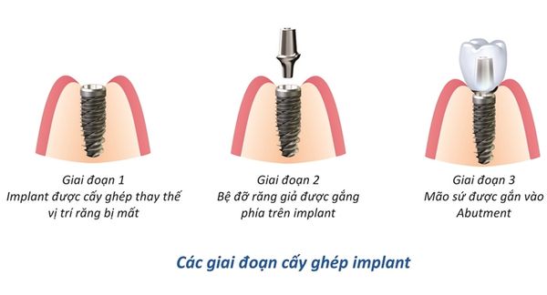 https://file.hstatic.net/1000259350/file/quy-trinh-cay-ghep-rang-implant_grande.jpg