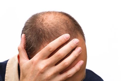 Có phải nam giới bị bạc tóc thì dễ bị hói đầu đúng không?