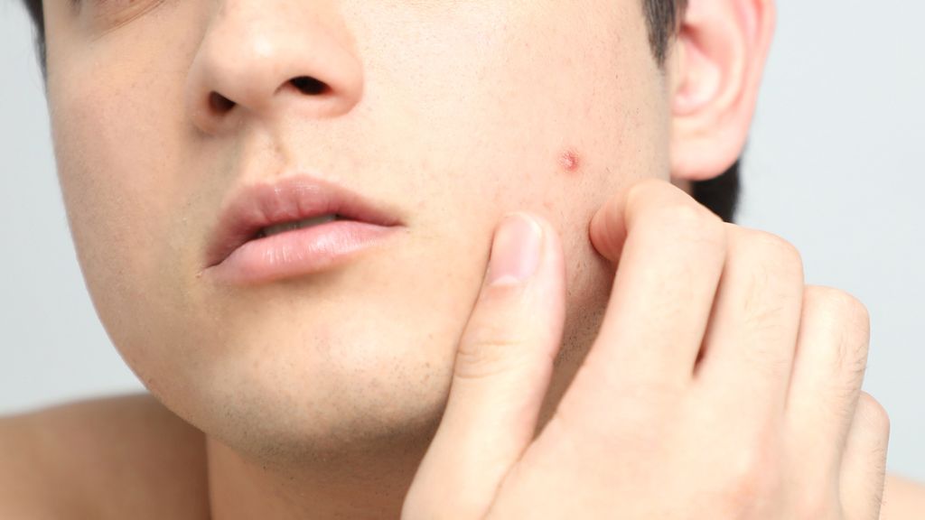 Khi Bị Mụn : Nên nặn hay không nặn ?
