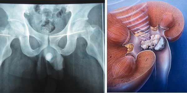 Những Điều Cần Biết Về Sỏi Niệu Đạo Ở Nam Giới!