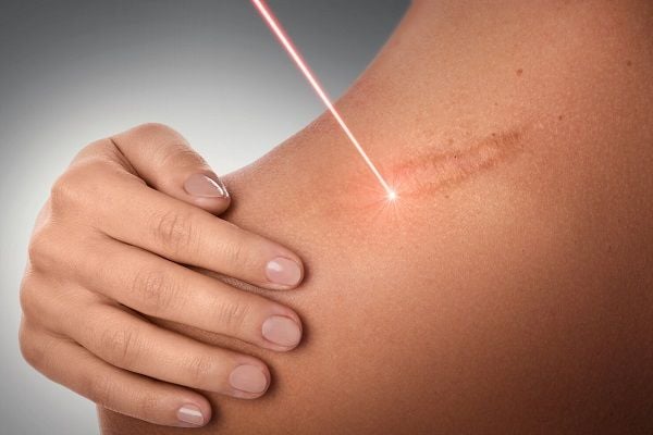 laser trị sẹo